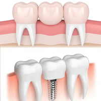 //iirorwxhloqjli5p.ldycdn.com/cloud/liBpkKloljSRrlmljlknjq/custom-healing-abutment-implant.jpg