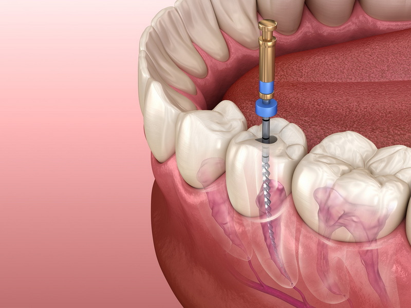 How Do I Stop My Abutment Screw From Moving?