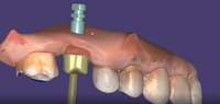//iirorwxhloqjli5p.ldycdn.com/cloud/liBpkKloljSRrlpkqkjljq/dental-abutment-manufacturers.jpg