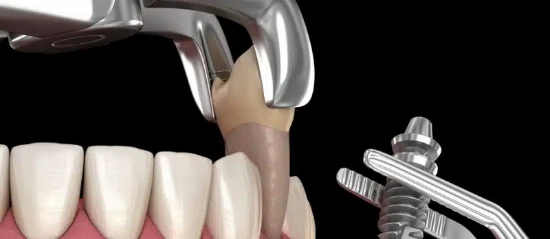 can a dental implant be placed immediately after extraction