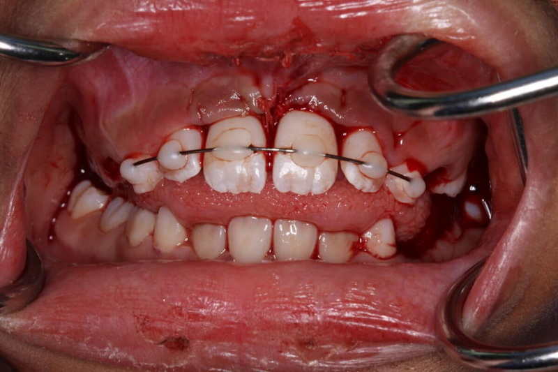 can i spar with a dental implant