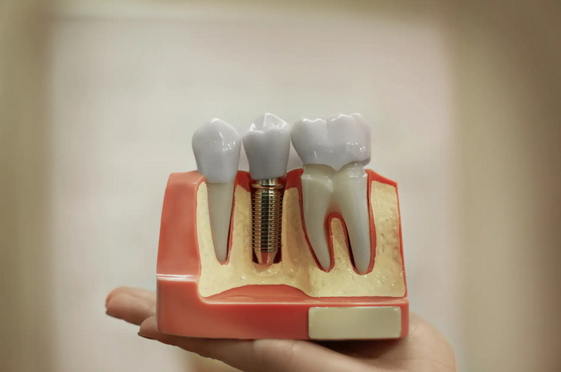 What Should I Do If My Abutment Screw Fell Out?