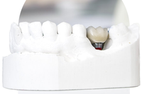 //iirorwxhloqjli5p.ldycdn.com/cloud/liBpkKloljSRrlqlllojjq/can-you-get-dental-implant-while-pregnant.png