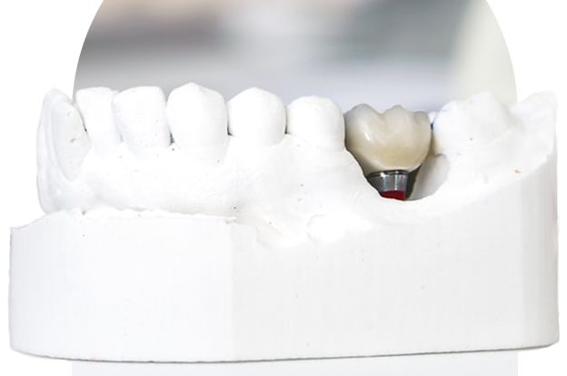 Can You Get Dental Implant While Pregnant?