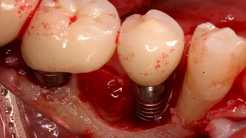 Can A Dental Implant Fall Out on Its Own?