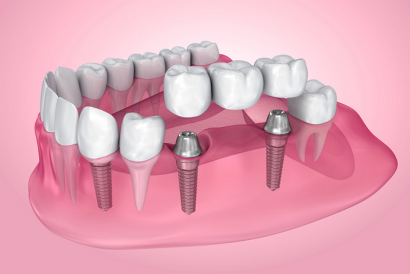 Can Copd Patients Have Dental Implant?