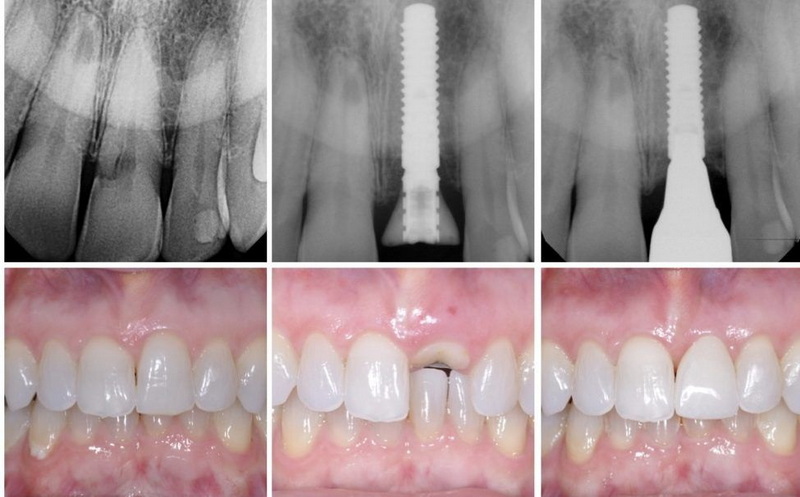 Which Dental Abutment Type Is Best For You?