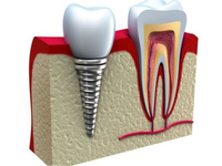 //iirorwxhloqjli5p.ldycdn.com/cloud/liBpkKloljSRrlrliqiljo/3i-external-hex-implant-abutment-screw.jpg