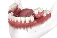 //iirorwxhloqjli5p.ldycdn.com/cloud/liBpkKloljSRrlrlnlrljo/can-you-eat-with-a-flipper-after-dental-implant-surgery.jpg