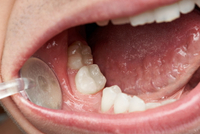 //iirorwxhloqjli5p.ldycdn.com/cloud/liBpkKloljSRrlrlpookjq/can-you-get-a-dry-socket-after-a-dental-implant.jpg