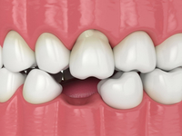 //iirorwxhloqjli5p.ldycdn.com/cloud/liBpkKloljSRrlrlrqppjq/osstem-abutment-screw.jpg