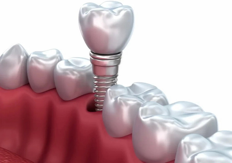can you shape an dental implant