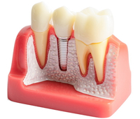 //iirorwxhloqjli5p.ldycdn.com/cloud/ljBpkKloljSRillinnjrjo/do-they-make-a-nickel-free-dental-implant.jpg
