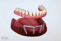 //iirorwxhloqjli5p.ldycdn.com/cloud/ljBpkKloljSRilnjmnjljq/does-a-dental-implant-feel-like-a-real-tooth.jpg
