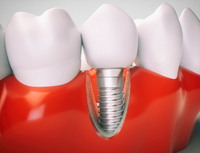 //iirorwxhloqjli5p.ldycdn.com/cloud/ljBpkKloljSRilprknnojq/factors-affecting-the-abutment-screw-loosening.jpg