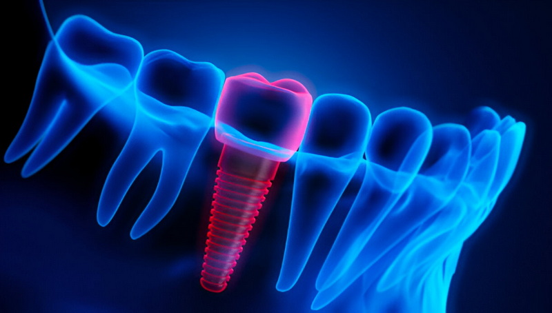 what can you eat after dental implant surgery_15