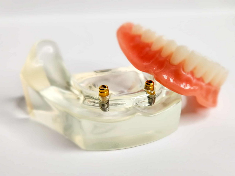how do you know if a dental implant has failed
