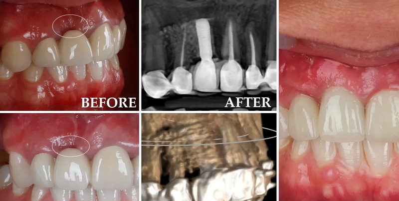 How Long To Eat After Dental Implant?