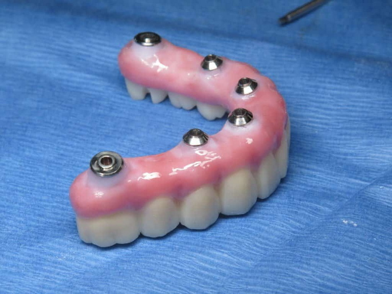 How Long for Dental Implant Process?