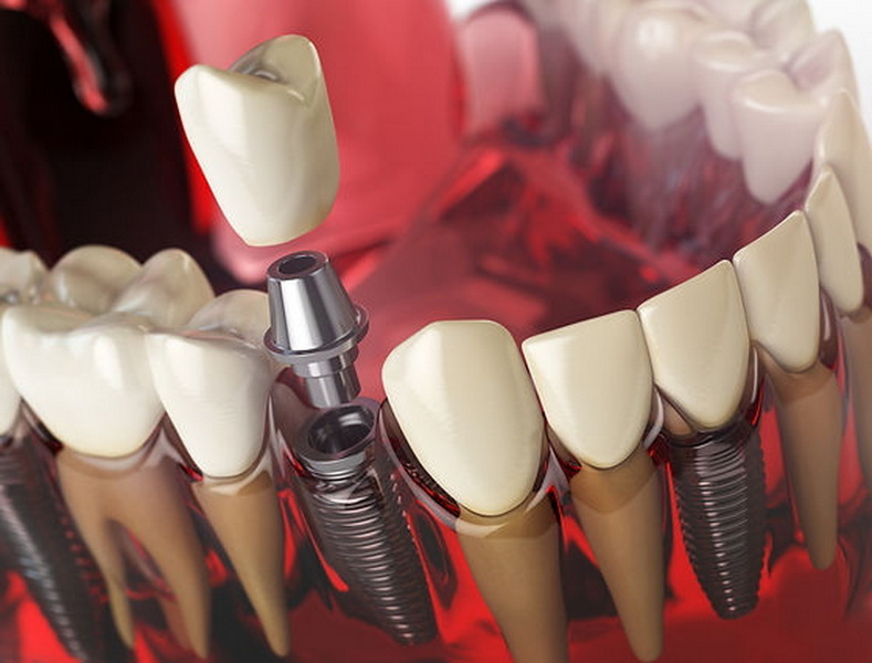 use mouthwash after dental implant surgery_1