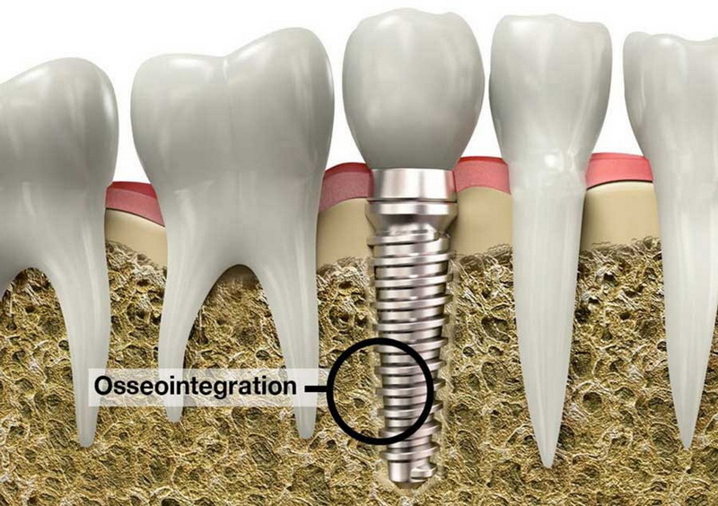 Can You Get A Dental Implant Months After Extraction?