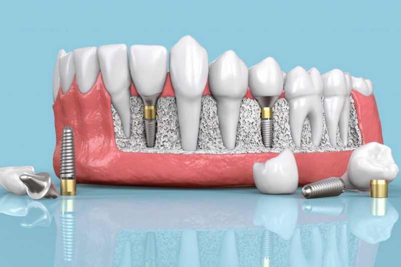 can dental implant be done in one day_1