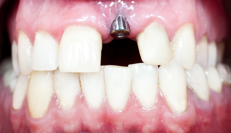 loose dental implant be repaired_1