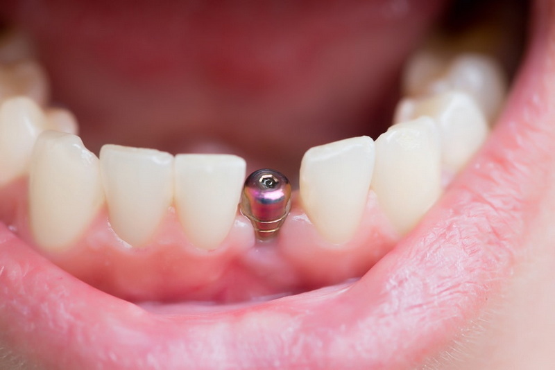 how long does it take to have a dental implant_08