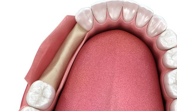 What Happens When A Dental Implant Is Removed?