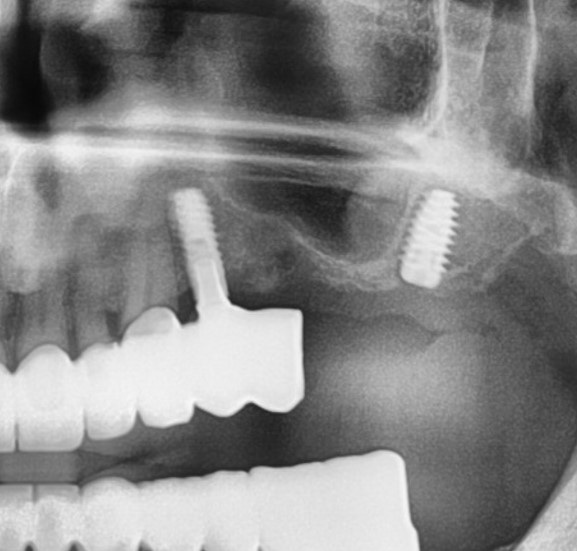 my dental implant hurt_3