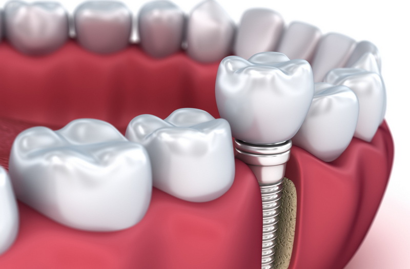 what's a mini dental implant_3
