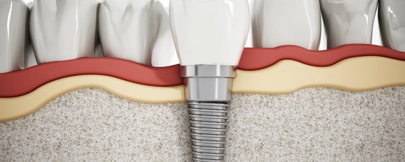what is best dental implant company_3
