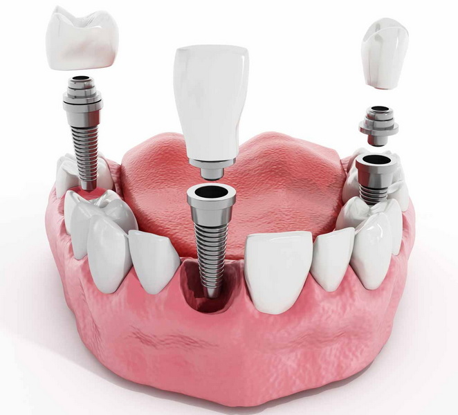 what is a dental implant torque test_2