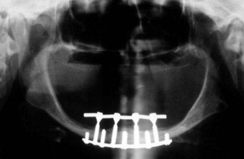  after dental implant_1