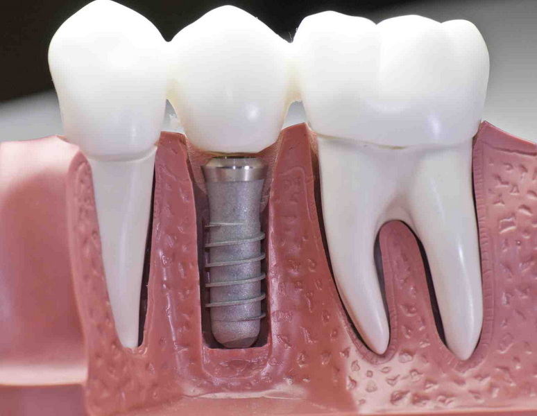 what happens dental implant gets infected_1