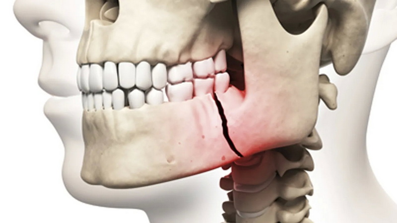Is My Dental Implant Failing?