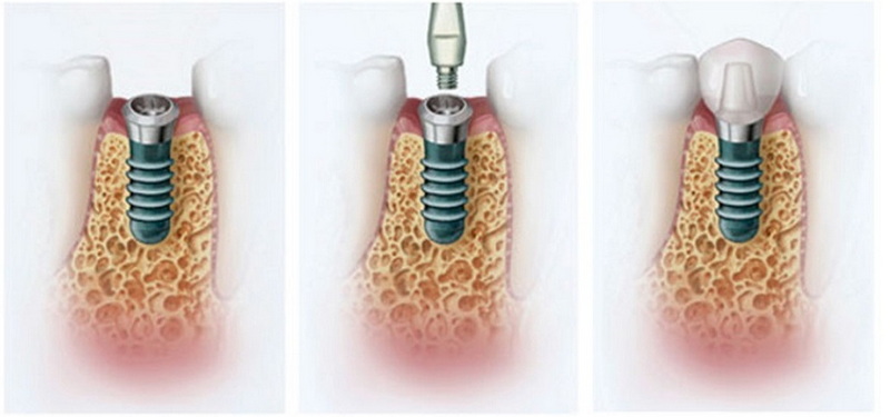 what dental implant involve_1