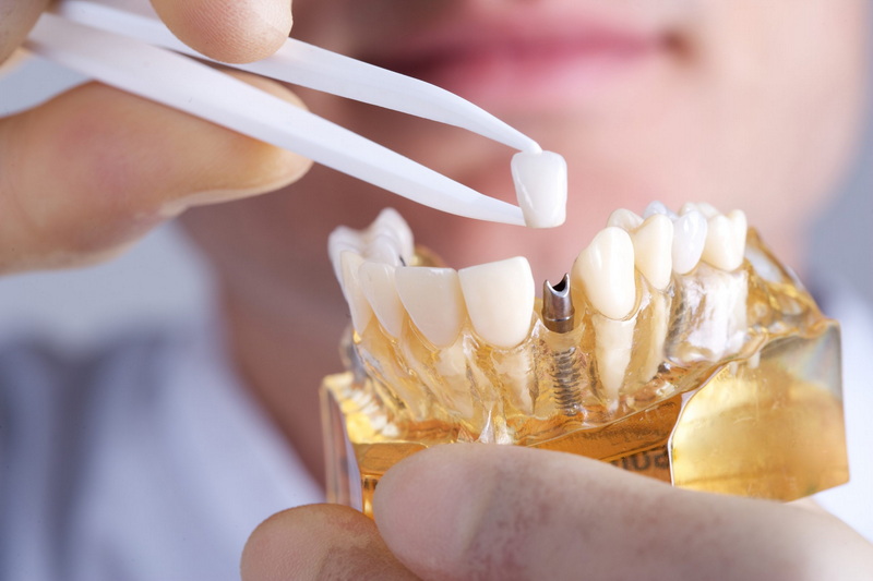 Should You Take Antibiotics After A Dental Implant?