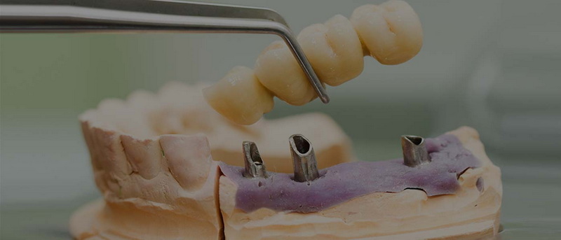 go wrong with a dental implant_1