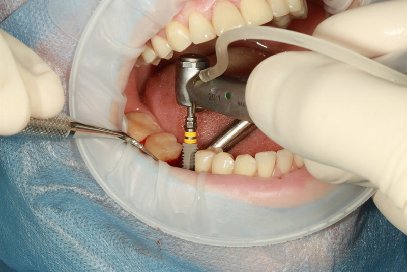 how long does dental implant healing take_24