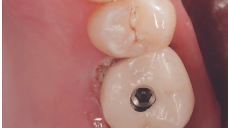 What To Expect After Getting A Dental Abutment?