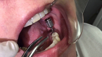 //iirorwxhloqjli5p.ldycdn.com/cloud/ljBpkKloljSRrlinlqirjo/abutment-screw-loosening-dental-implant.jpg