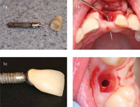 //iirorwxhloqjli5p.ldycdn.com/cloud/ljBpkKloljSRrlinnqlojq/abutment-screw-loosening-in-single-implant-restorations-a-systematic-review.jpg