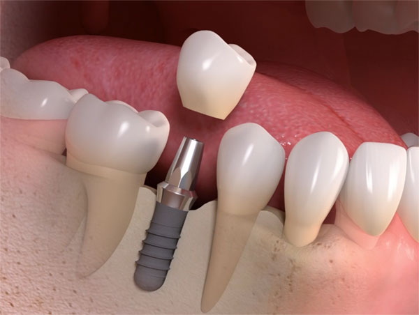 what to expect from dental implant surgery