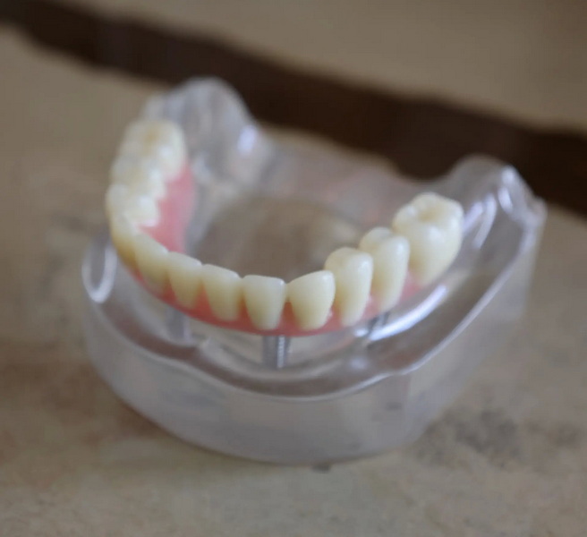 what is the recovery time for a dental implant