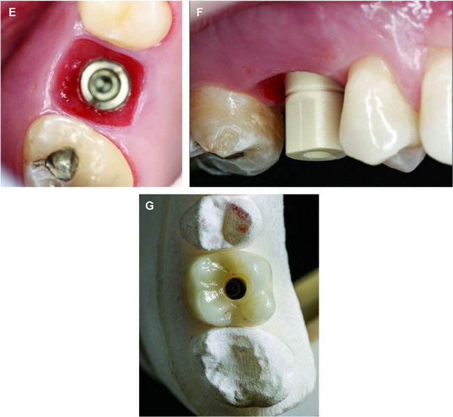 Can You Do An Dental Implant in 1 Visit?