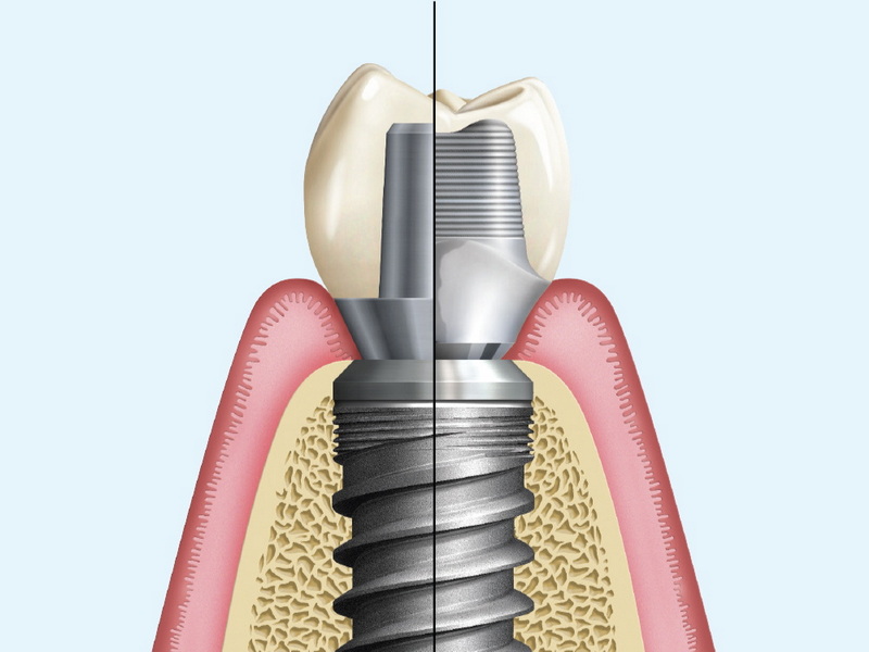 How To Clean And Care for A Dental Healing Abutment?