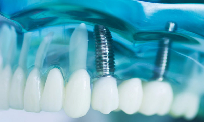 Do Dental Implant Screws Need To Be Replaced?