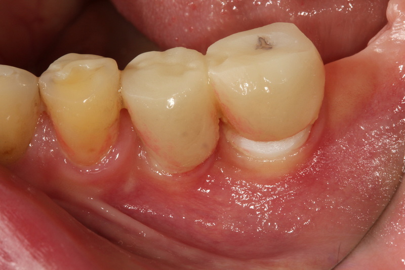 How Long Between Implant And Healing Abutment Placement?