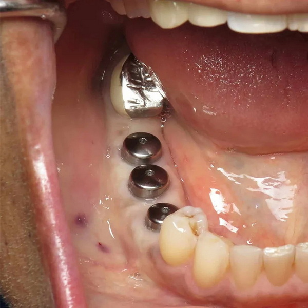 How Do You Care for An Implant with A Healing Abutment?